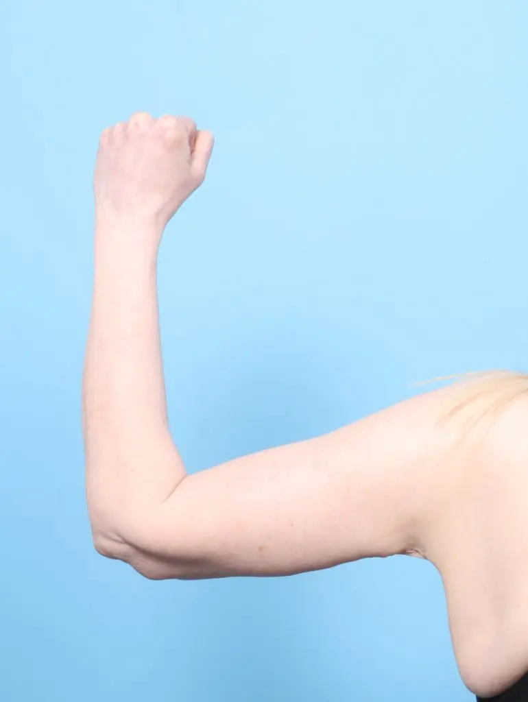 After Weight Loss - Case 60653 - After