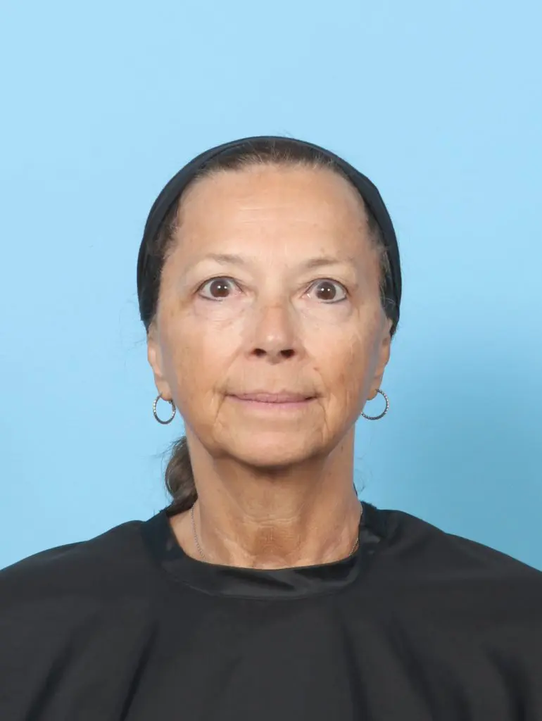 Eyelid Surgery - Case 60659 - Before