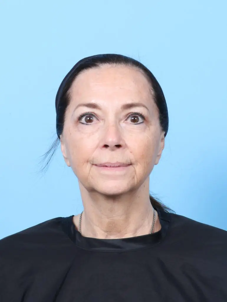 Eyelid Surgery - Case 60659 - After