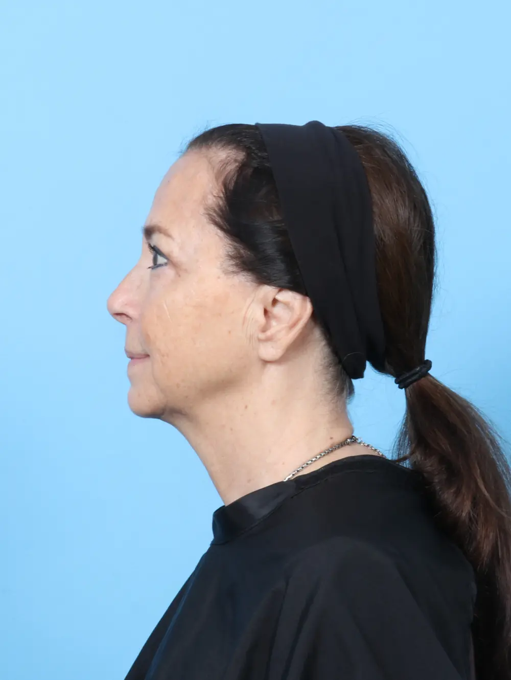 Eyelid Surgery Patient Photo - Case 60659 - after view-2