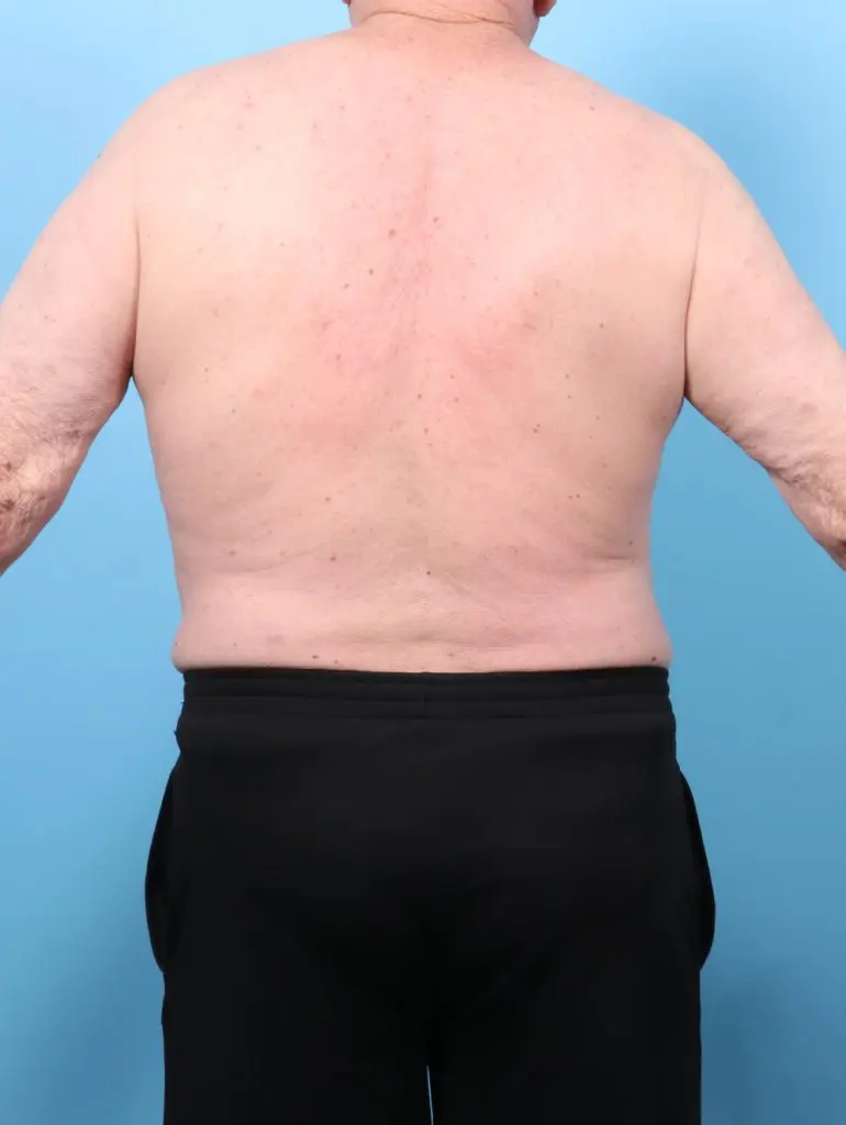 Liposuction - Case 60667 - After