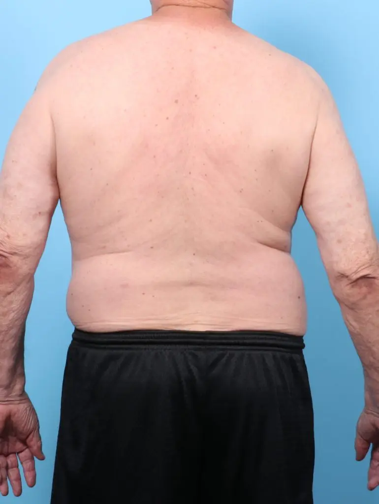 Liposuction - Case 60667 - Before