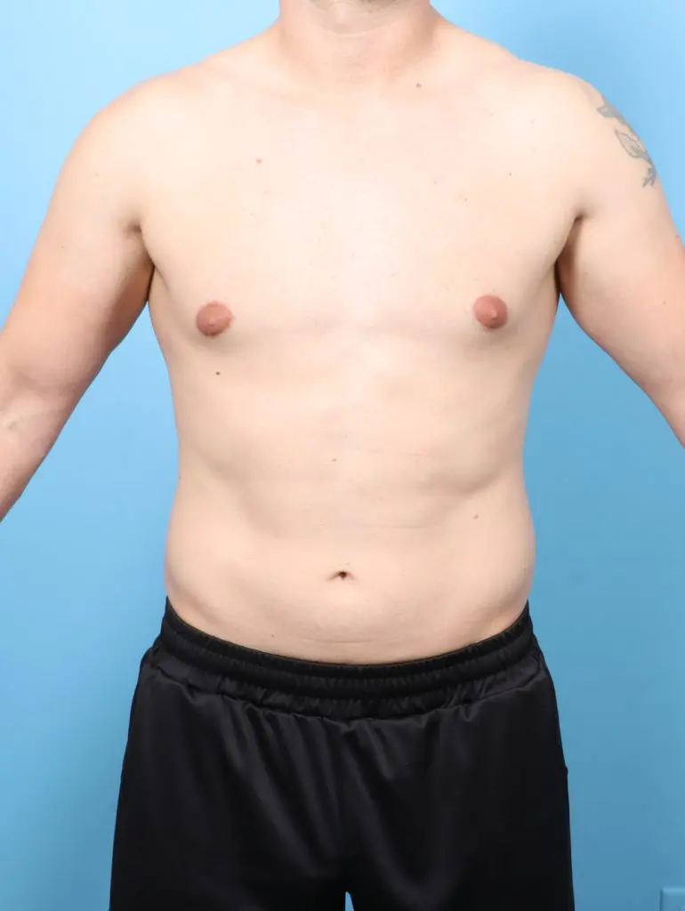 Gynecomastia - Case 60715 - After