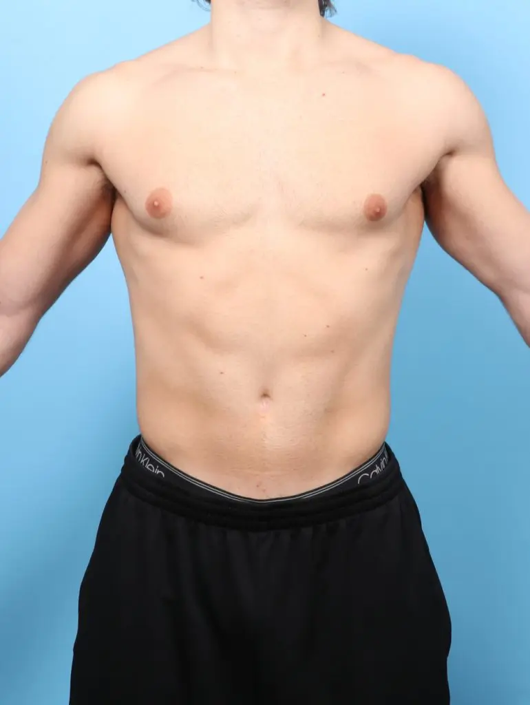 Gynecomastia - Case 60723 - Before