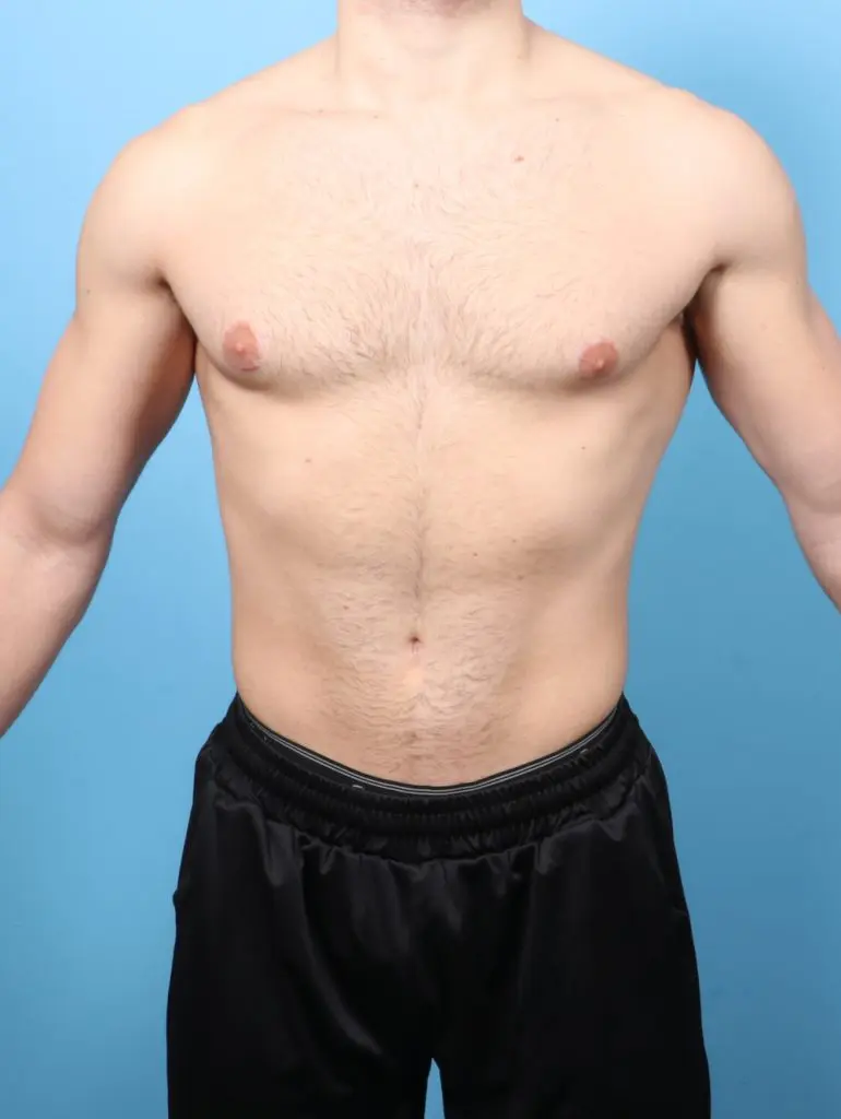 Gynecomastia - Case 60723 - After