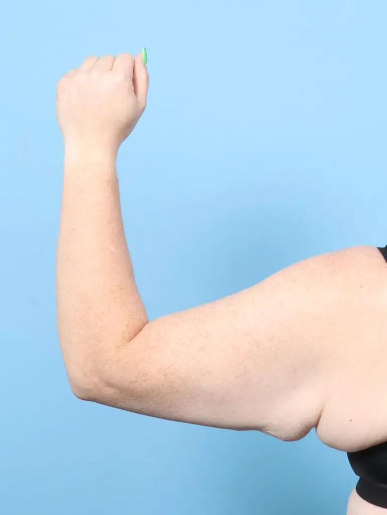 Arm Lift - Case 60739 - Before