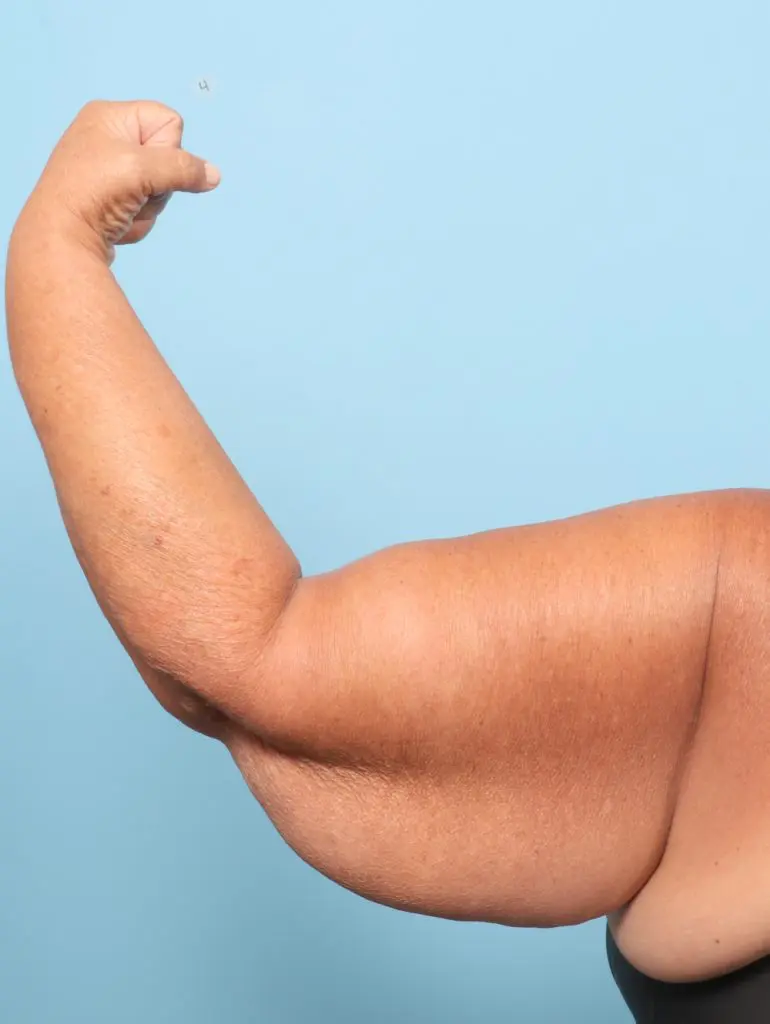 Arm Lift - Case 60764 - Before