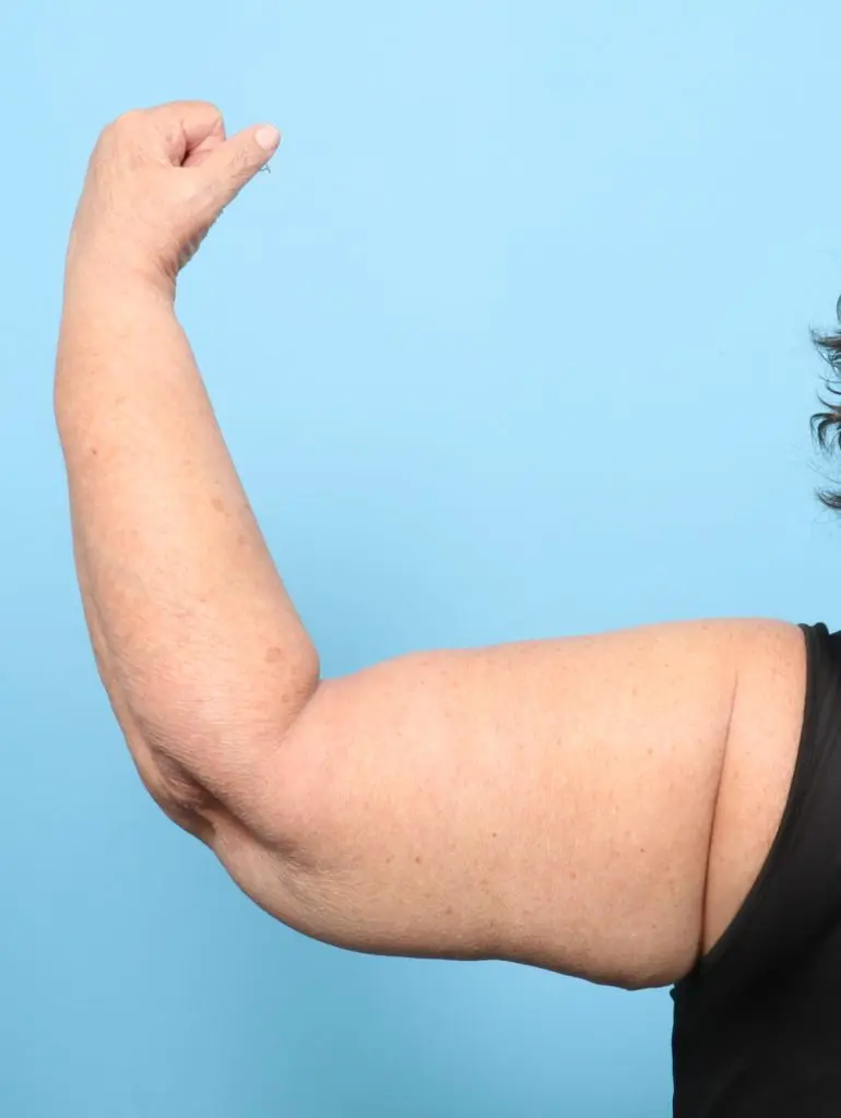 Arm Lift - Case 60764 - After