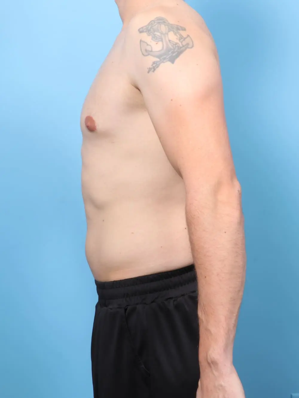 Gynecomastia Patient Photo - Case 60715 - after view-2