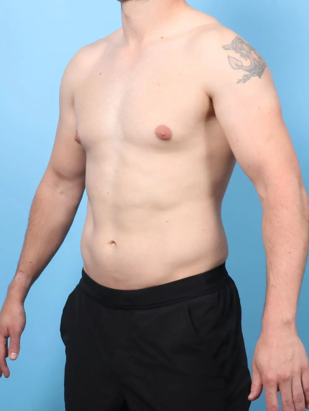 Gynecomastia Patient Photo - Case 60715 - before view-1