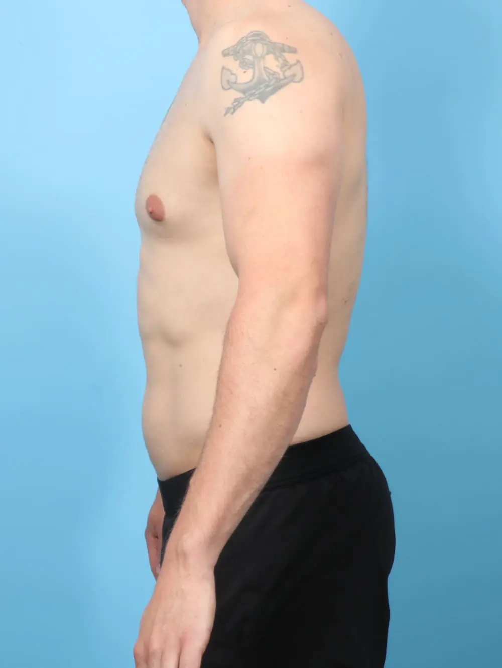 Gynecomastia Patient Photo - Case 60715 - before view-2