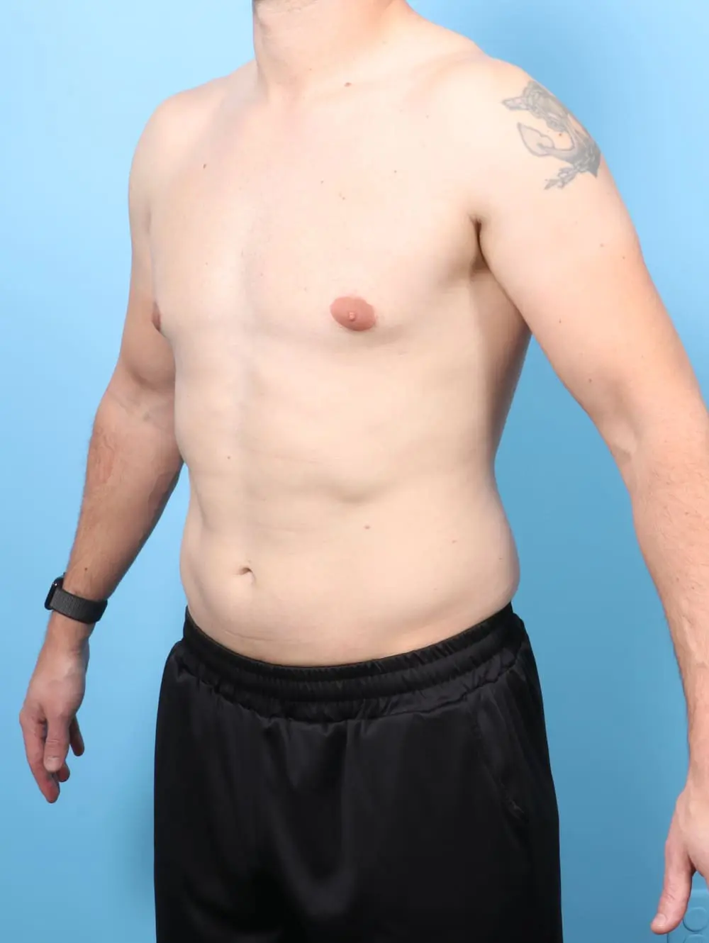 Gynecomastia Patient Photo - Case 60715 - after view-1
