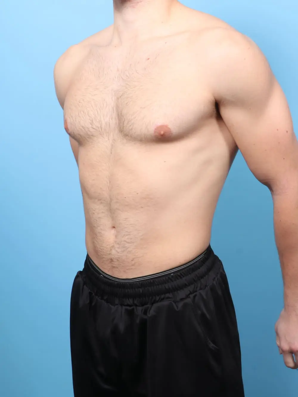 Gynecomastia Patient Photo - Case 60723 - after view-1