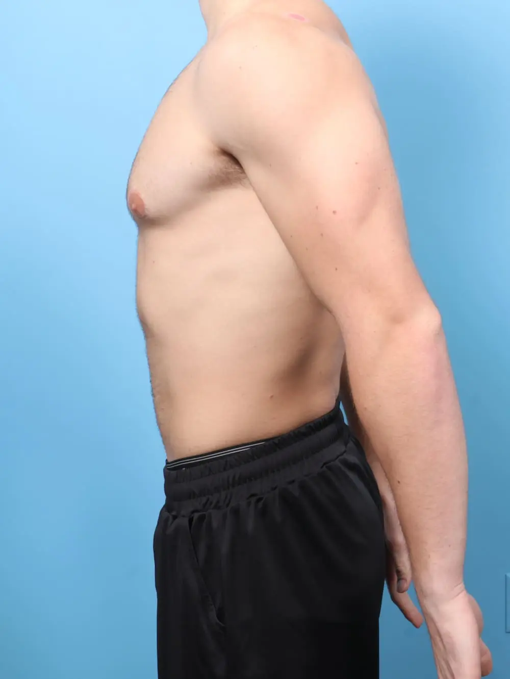 Gynecomastia Patient Photo - Case 60723 - after view-2