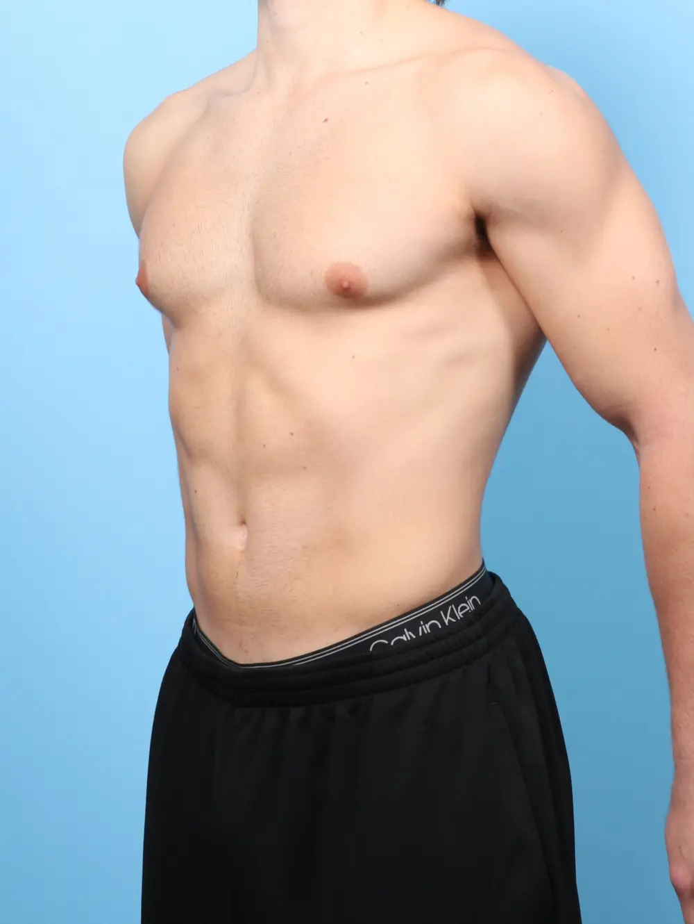 Gynecomastia Patient Photo - Case 60723 - before view-1