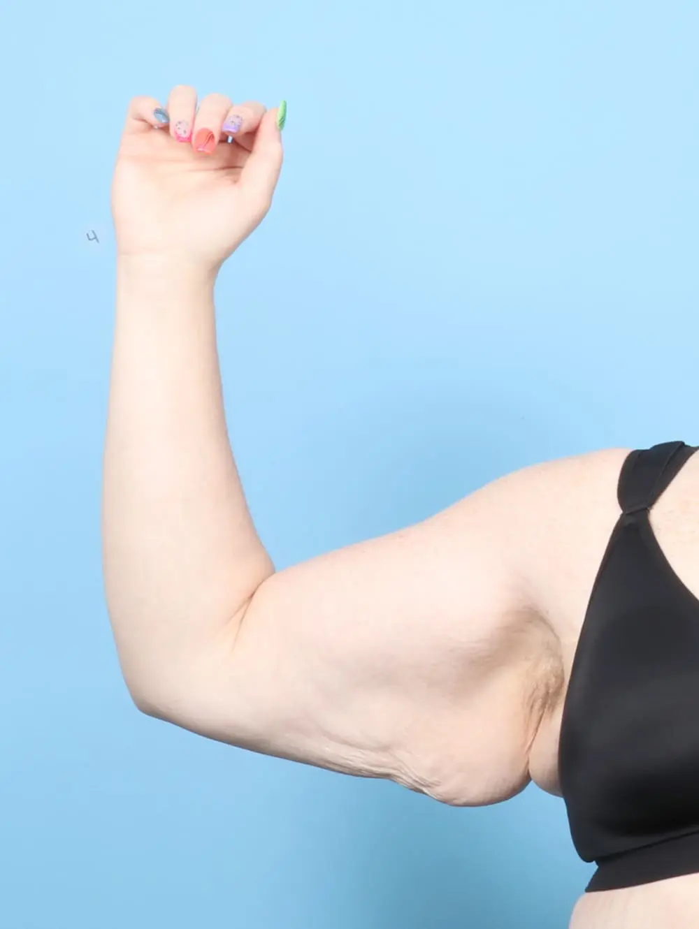 Arm Lift Patient Photo - Case 60739 - before view-1