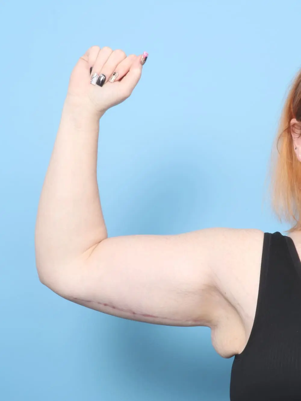 Arm Lift Patient Photo - Case 60739 - after view-1