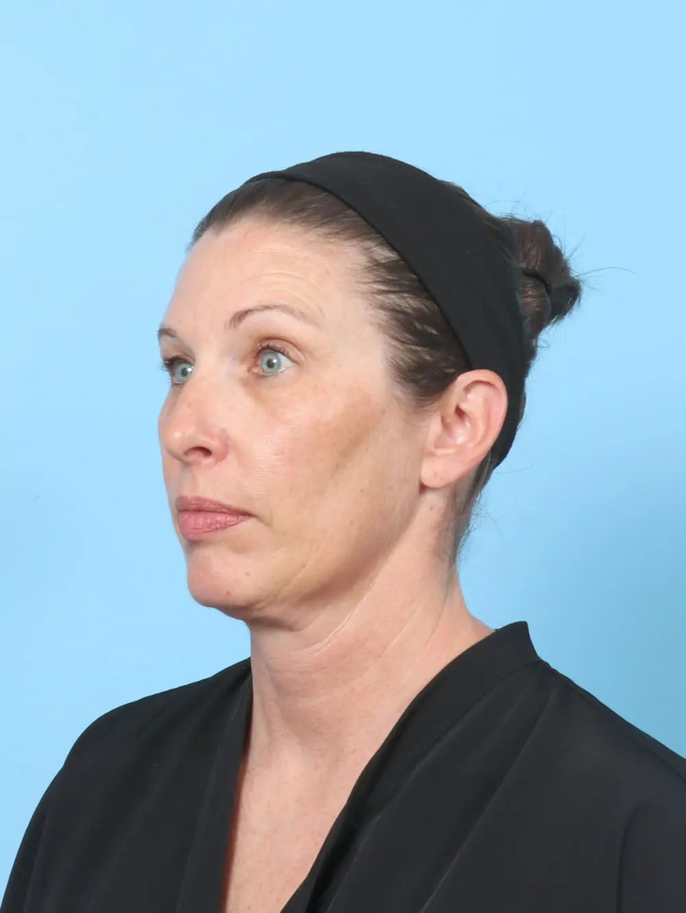 Eyelid Surgery Patient Photo - Case 60745 - before view-1