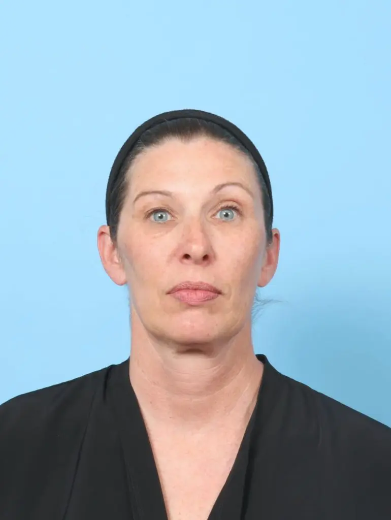 Eyelid Surgery - Case 60745 - Before