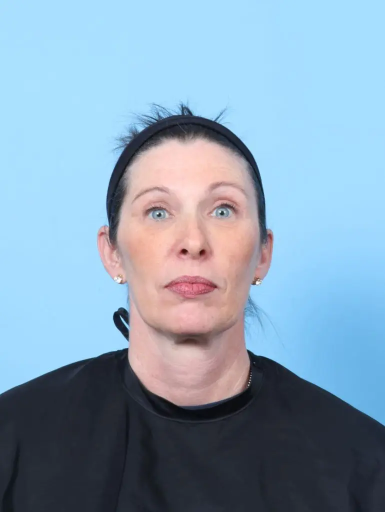 Eyelid Surgery - Case 60745 - After