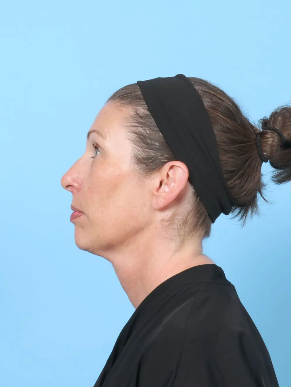 Eyelid Surgery Patient Photo - Case 60745 - before view-2