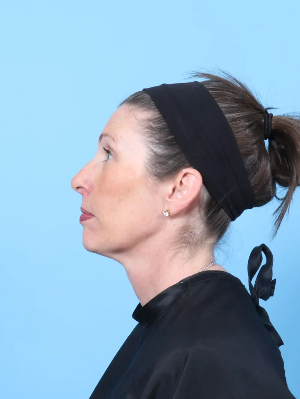 Eyelid Surgery Patient Photo - Case 60745 - after view-2