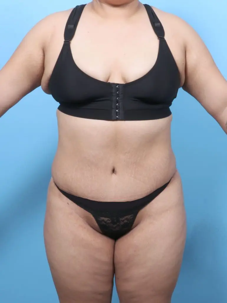 After Weight Loss - Case 60754 - After