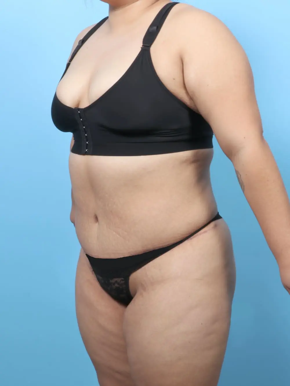After Weight Loss Patient Photo - Case 60754 - after view-1