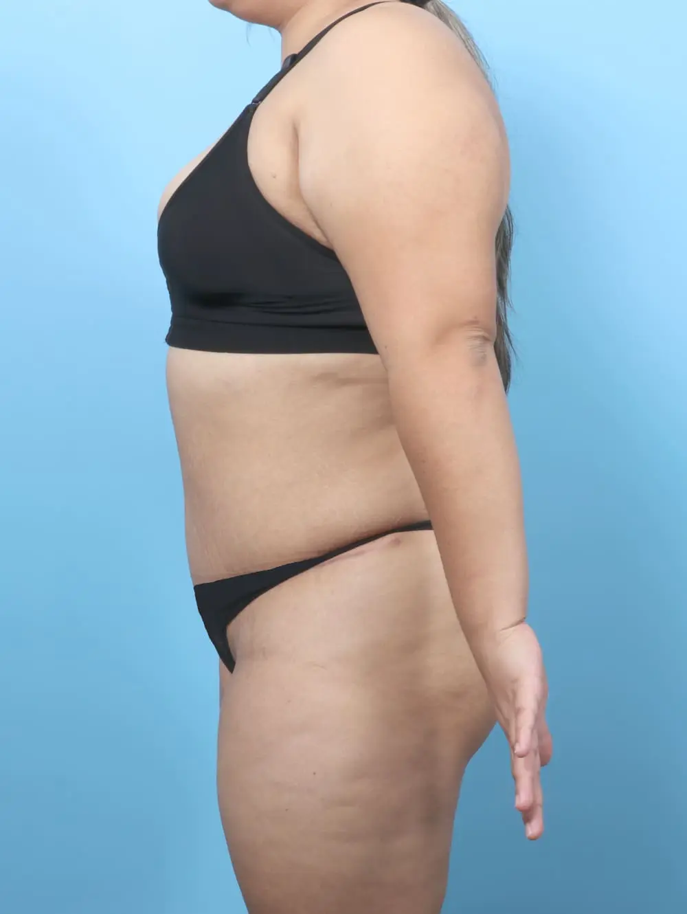 After Weight Loss Patient Photo - Case 60754 - after view-2