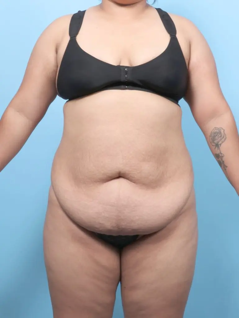 After Weight Loss - Case 60754 - Before