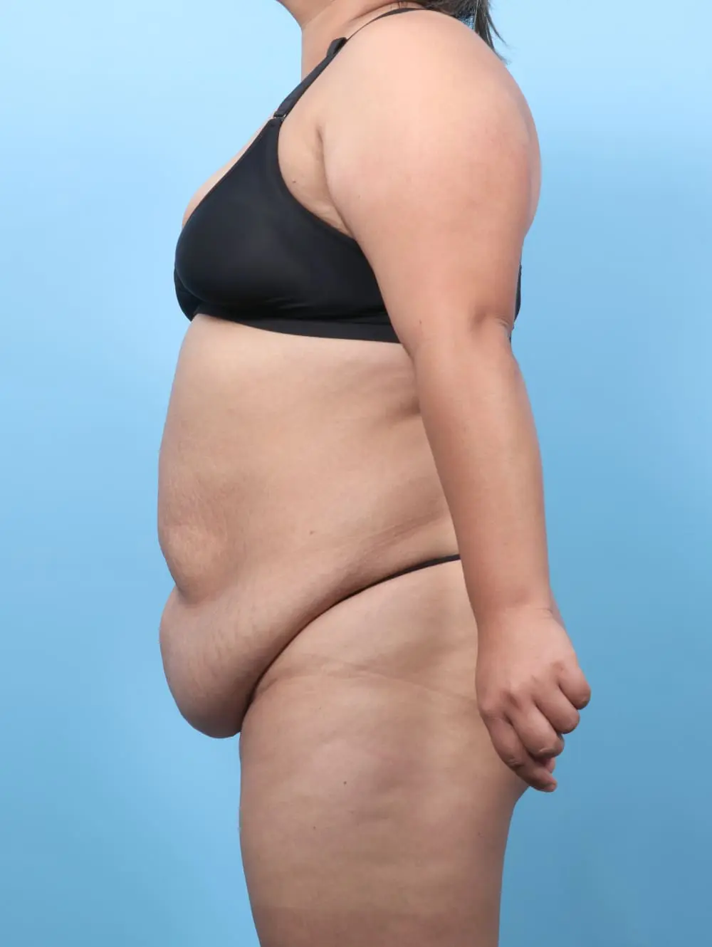 After Weight Loss Patient Photo - Case 60754 - before view-2