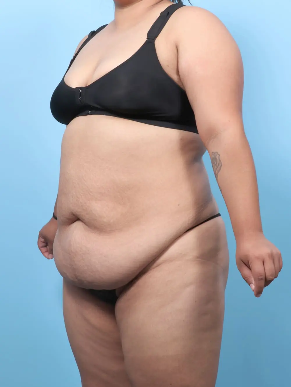 After Weight Loss Patient Photo - Case 60754 - before view-1
