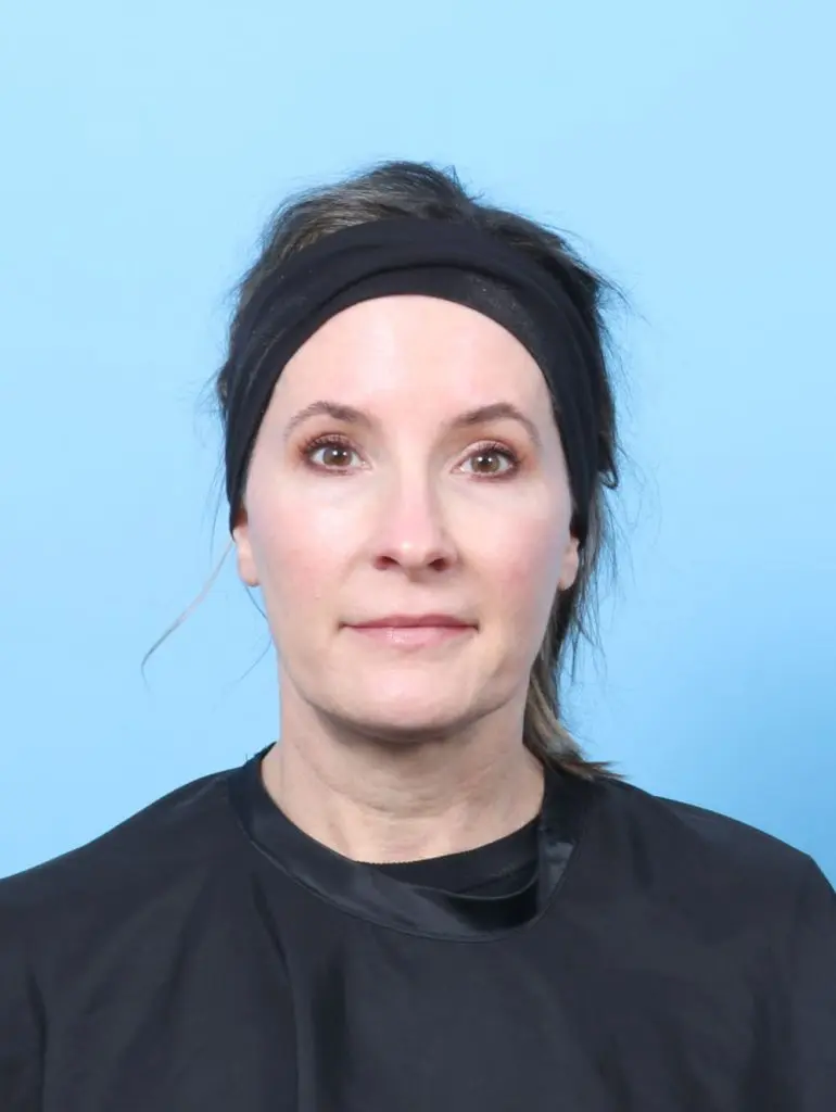 Eyelid Surgery - Case 60770 - After