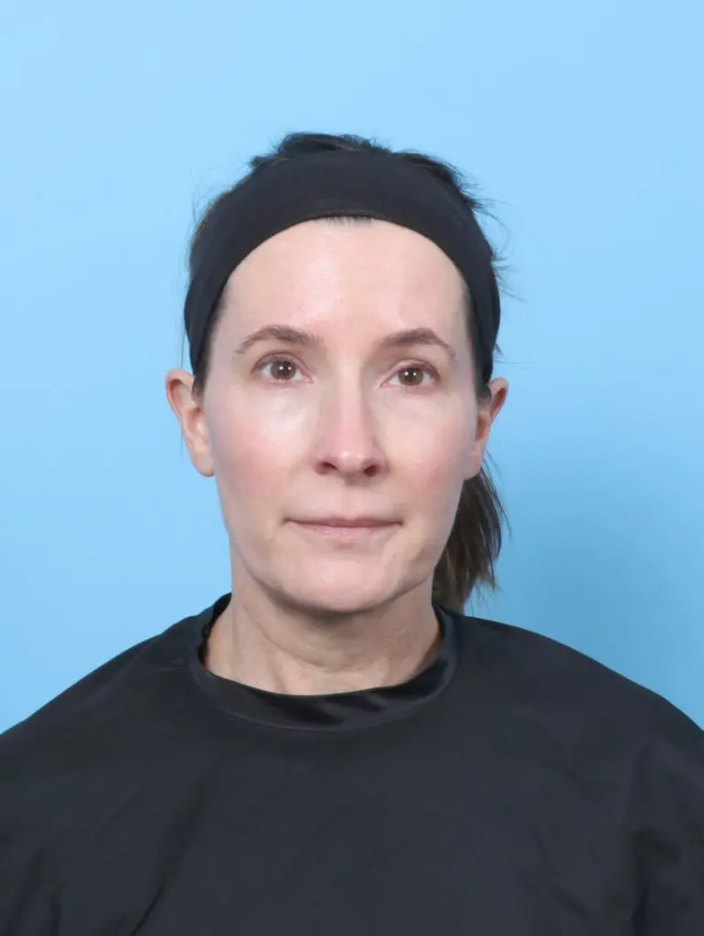 Eyelid Surgery - Case 60770 - Before