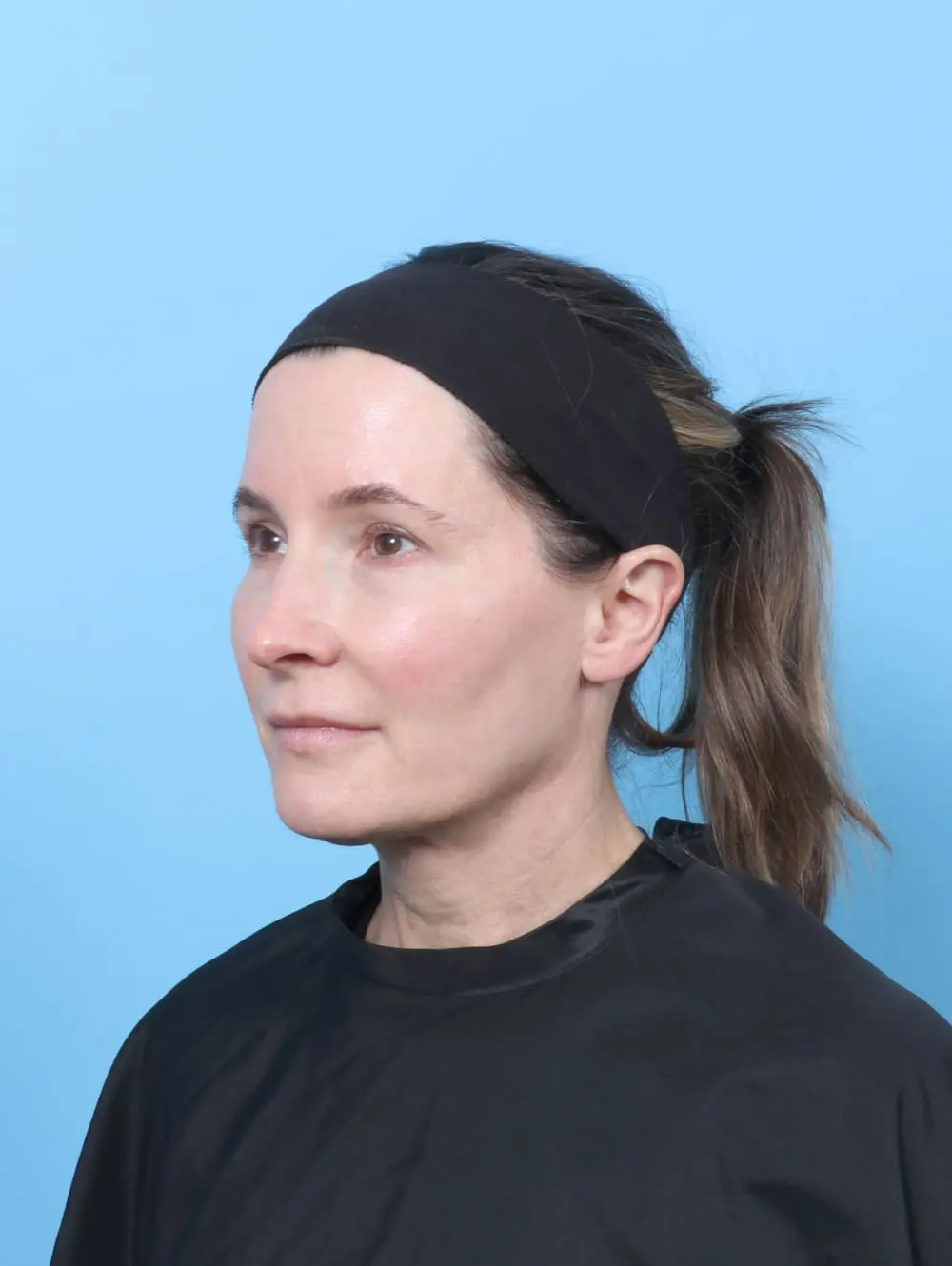 Eyelid Surgery Patient Photo - Case 60770 - before view-1