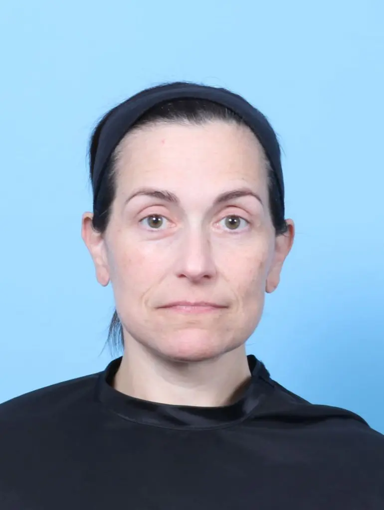 Eyelid Surgery - Case 60778 - After