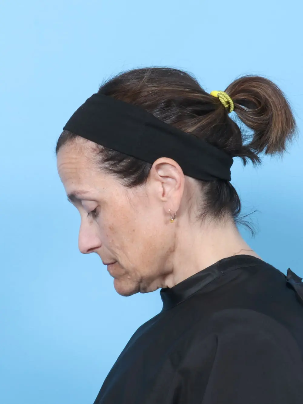 Eyelid Surgery Patient Photo - Case 60778 - before view-3