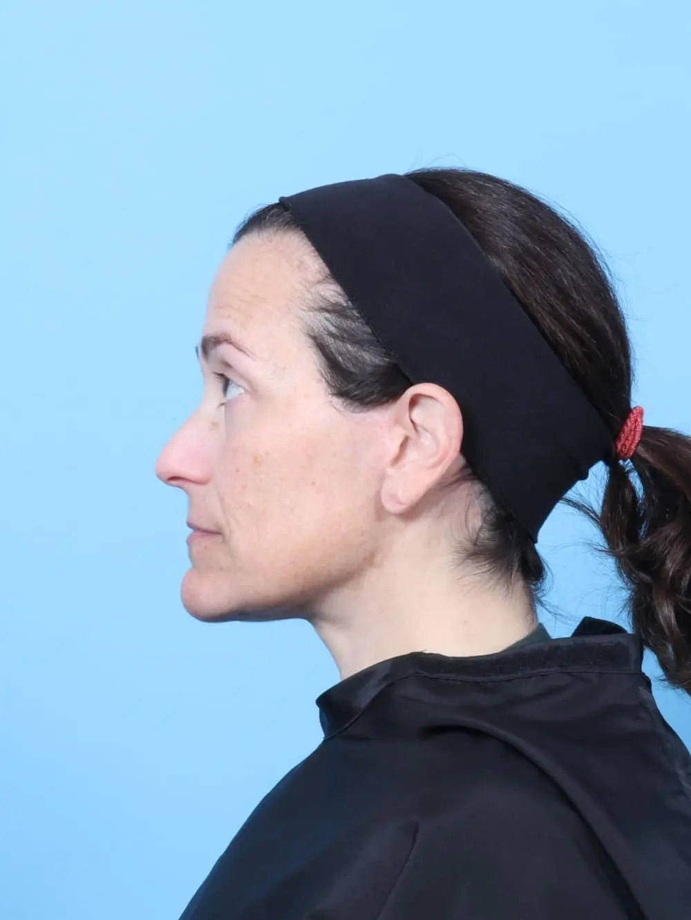 Eyelid Surgery Patient Photo - Case 60778 - after view-2