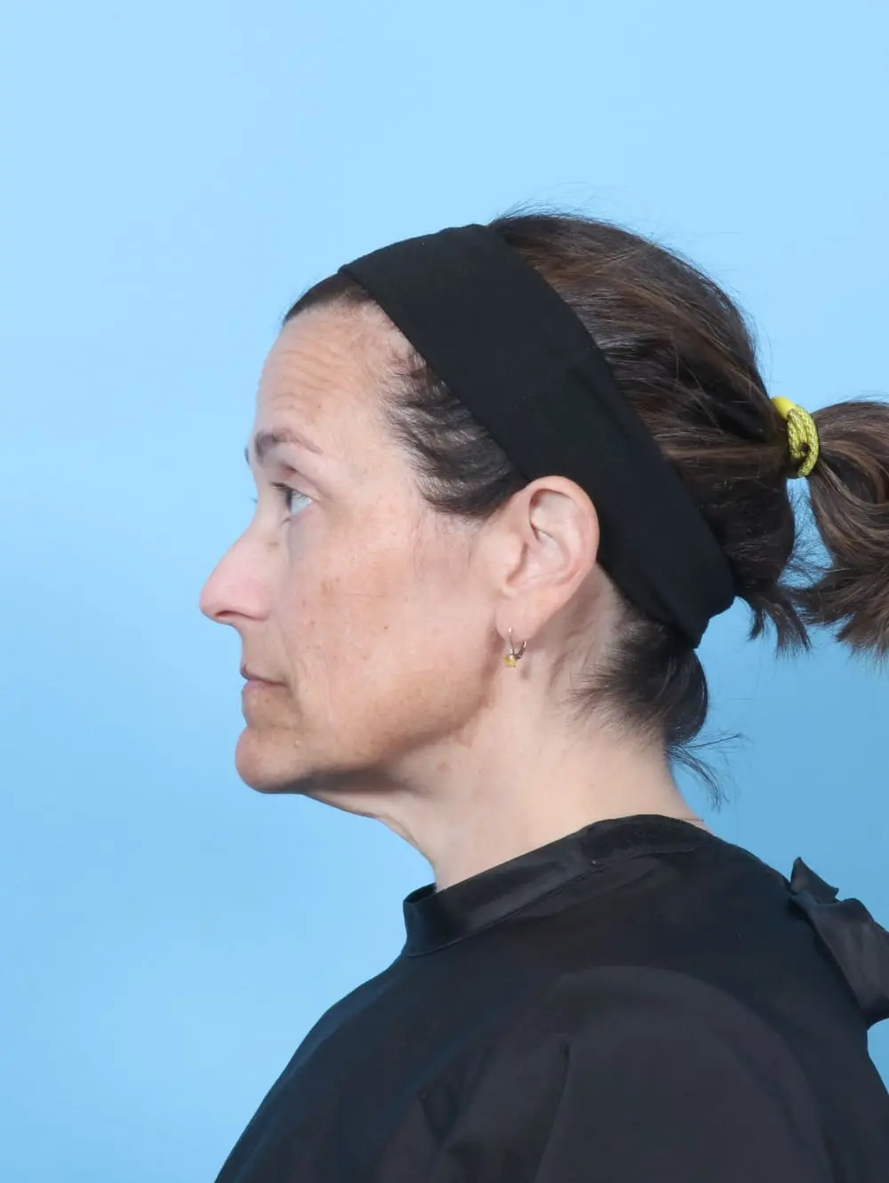 Eyelid Surgery Patient Photo - Case 60778 - before view-2