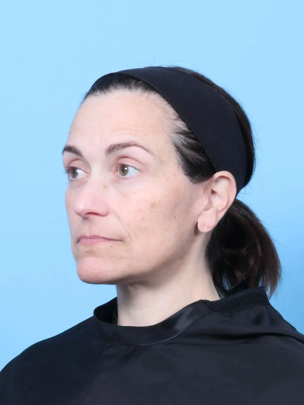 Eyelid Surgery Patient Photo - Case 60778 - after view-1