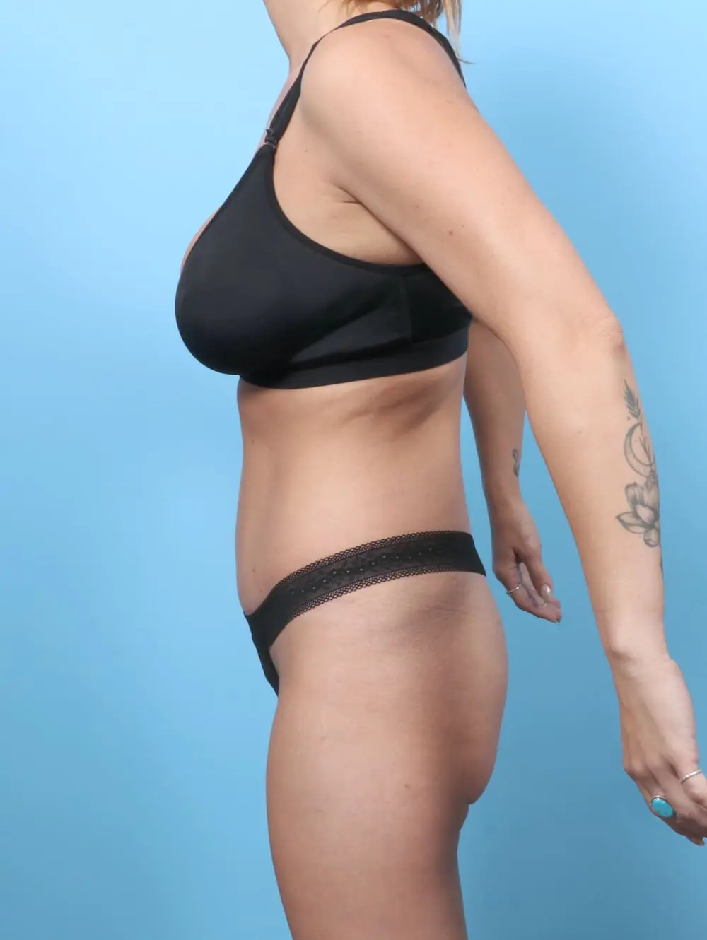 Tummy Tuck Patient Photo - Case 60788 - after view-2