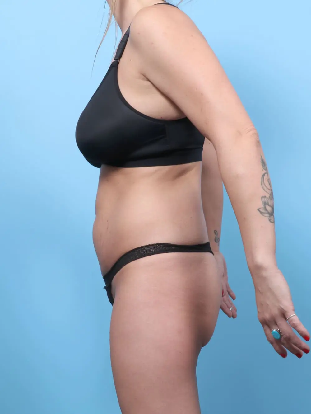 Tummy Tuck Patient Photo - Case 60788 - before view-2