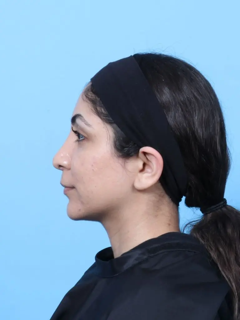 Rhinoplasty - Case 60796 - After