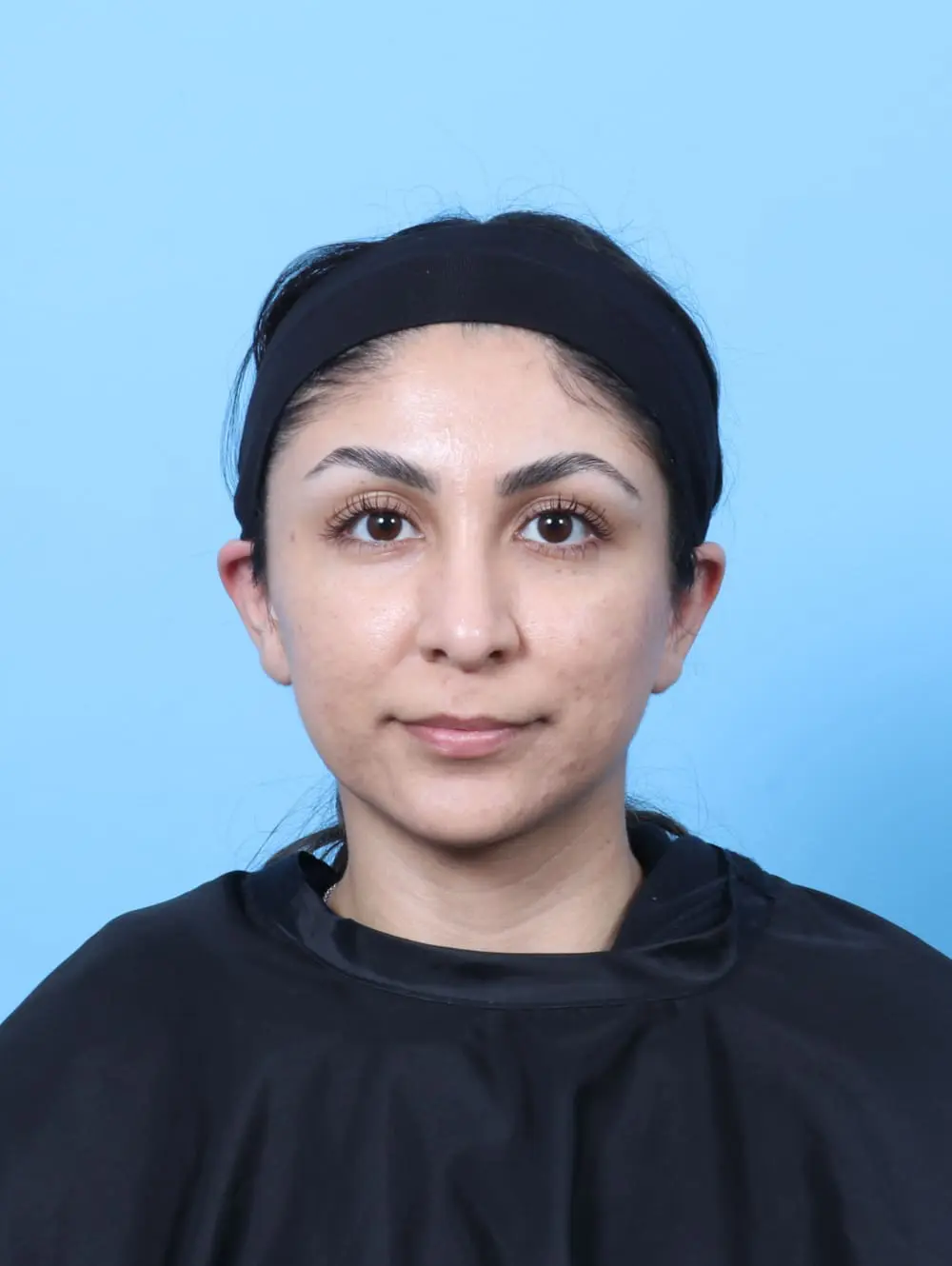 Rhinoplasty Patient Photo - Case 60796 - after view-2