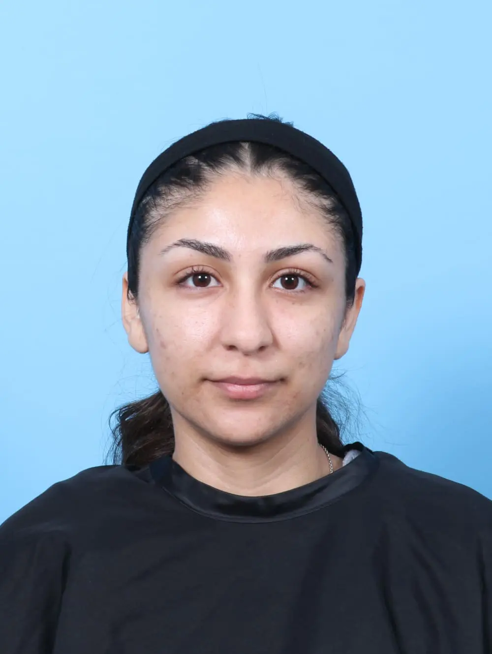 Rhinoplasty Patient Photo - Case 60796 - before view-2