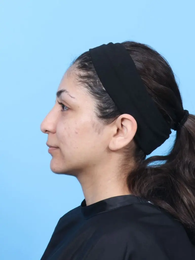 Rhinoplasty - Case 60796 - Before