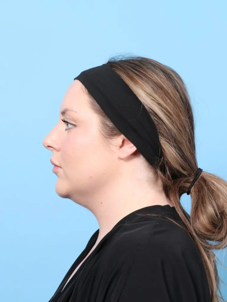 Submental Liposuction - Case 61522 - Before