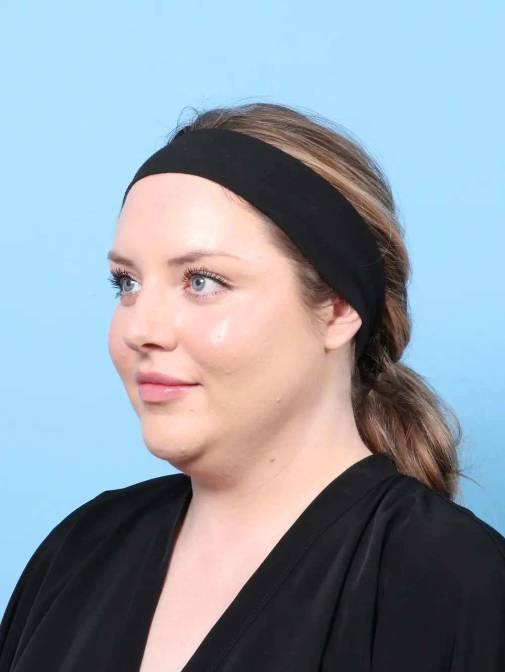 Submental Liposuction Patient Photo - Case 61522 - before view-1