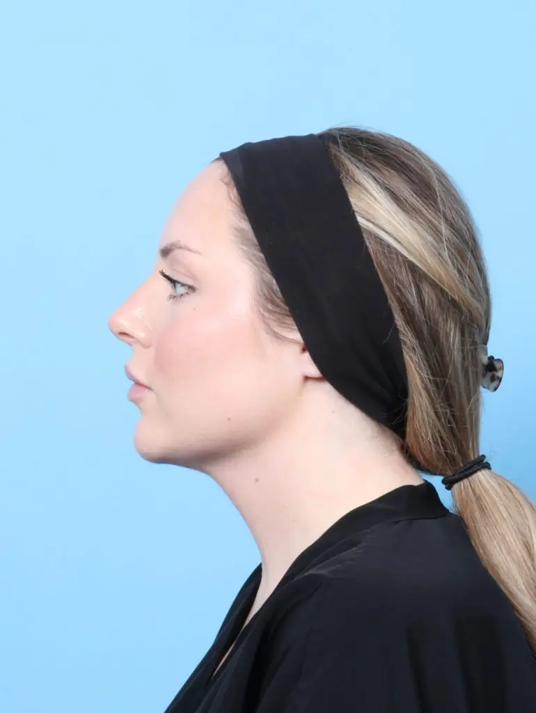 Submental Liposuction - Case 61522 - After