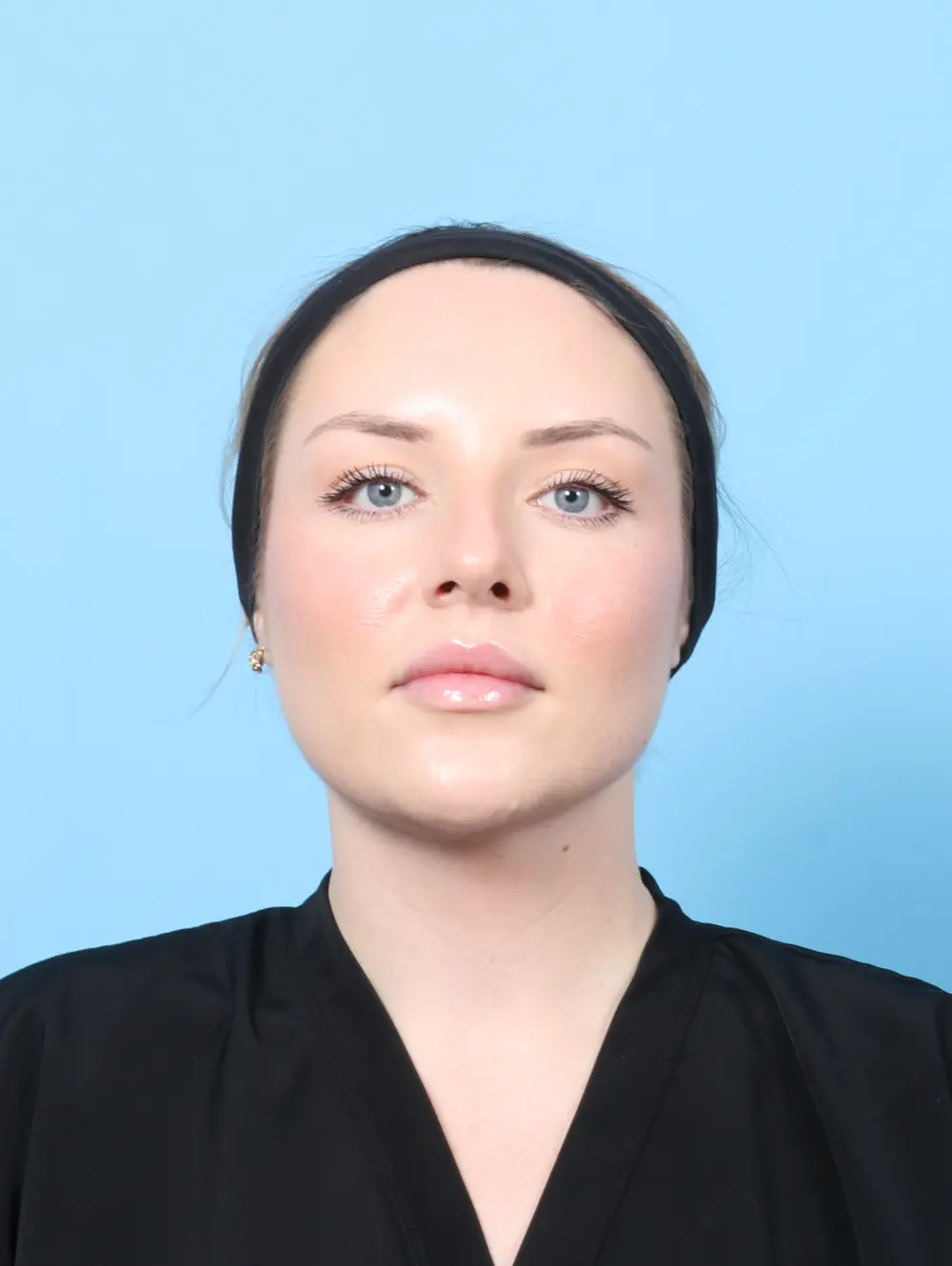 Submental Liposuction Patient Photo - Case 61522 - after view-2